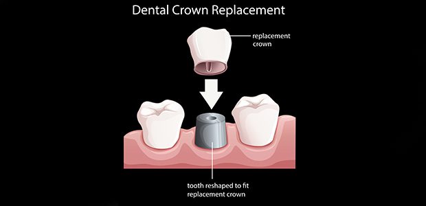 Dental Crown